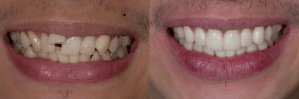 conditions that porcelain veneers can correct